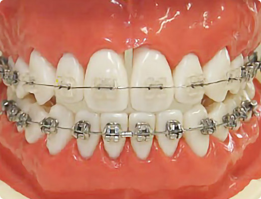 矯正歯科器具：クリアブラケット
